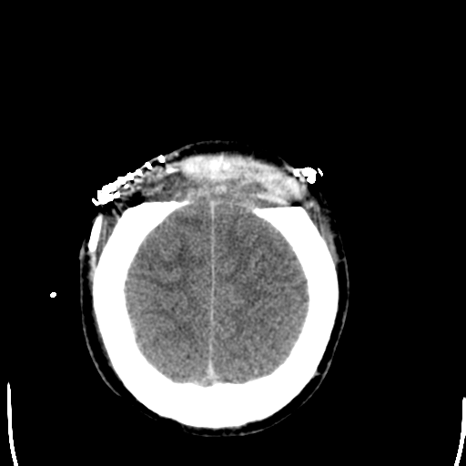 File:Cerebral hemorrhagic contusions- temporal evolution (Radiopaedia 40224-42755 AXIAL THICK 27).png