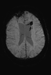 File:Cerebral hemorrhagic contusions- temporal evolution (Radiopaedia 40224-42757 Axial SWI 23).png
