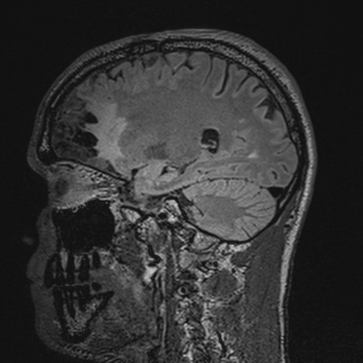 File:Cerebral hemorrhagic contusions- temporal evolution (Radiopaedia 40224-42757 Sagittal T1 52).png