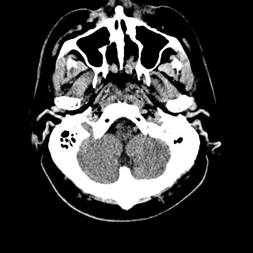 File:Cerebral hemorrhagic contusions and cervical spine fractures (Radiopaedia 32865-33841 Axial non-contrast 5).jpg