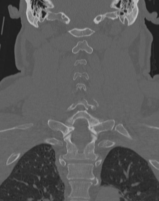 Cerebral hemorrhagic contusions and cervical spine fractures (Radiopaedia 32865-33841 Coronal bone window 45).jpg