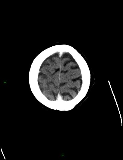 Cerebral metastases - ependymal and parenchymal (Radiopaedia 79877-93131 Axial C+ delayed 76).jpg