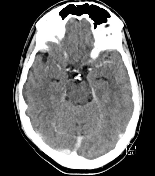 Cerebral metastases - testicular choriocarcinoma (Radiopaedia 84486-99855 Axial C+ delayed 36).jpg