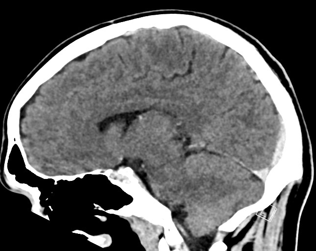 Cerebral metastases - testicular choriocarcinoma (Radiopaedia 84486-99855 F 33).jpg