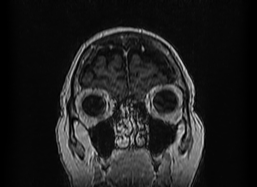 Cerebral metastases from lung cancer with amyloid angiopathy and cerebellopontine angle meningioma (Radiopaedia 74306-85191 Coronal T1 C+ 6).jpg