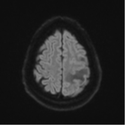 Cerebral metastases mimicking multifocal glioblastoma (Radiopaedia 50843-56353 Axial DWI 50).png