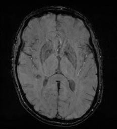 Cerebral metastasis - melanoma (Radiopaedia 54718-60954 Axial SWI 29).png