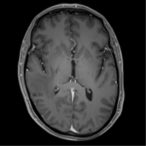 Cerebral metastasis - melanoma (Radiopaedia 54718-60954 Axial T1 C+ fat sat 27).png