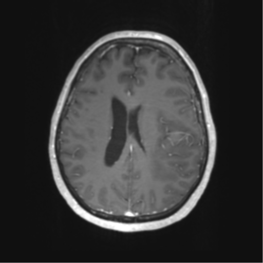 File:Cerebral metastasis mimicking glioblastoma (Radiopaedia 69155-78937 Axial T1 C+ 43).png