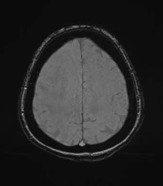 File:Cerebral metastasis to basal ganglia (Radiopaedia 81568-95413 Axial SWI magnitude 70).png