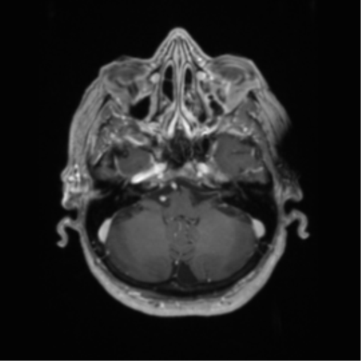 Cerebral metastasis to basal ganglia (Radiopaedia 81568-95413 Axial T1 C+ 15).png