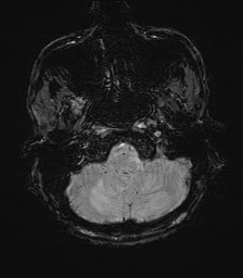 File:Cerebral toxoplasmosis (Radiopaedia 43956-47461 Axial SWI 5).jpg