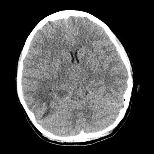 Cerebral tuberculosis with dural sinus invasion (Radiopaedia 60353-68018 Axial non-contrast 24).jpg