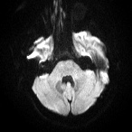 File:Cerebral venous infarction - hemorrhagic (Radiopaedia 81625-95505 Axial DWI 5).jpg