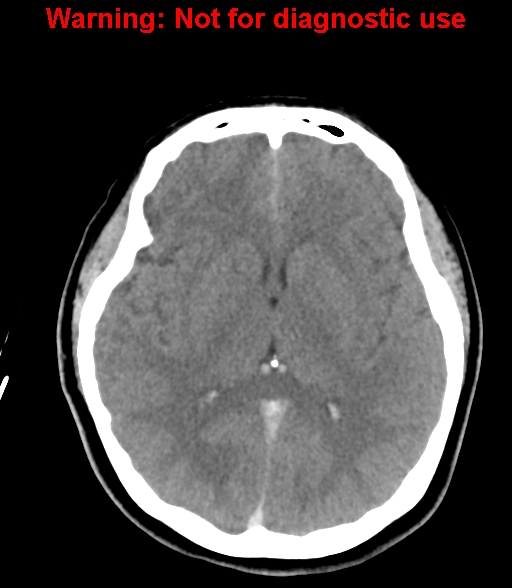 File:Cerebral venous thrombosis (Radiopaedia 37224-38992 Axial non-contrast 15).jpg