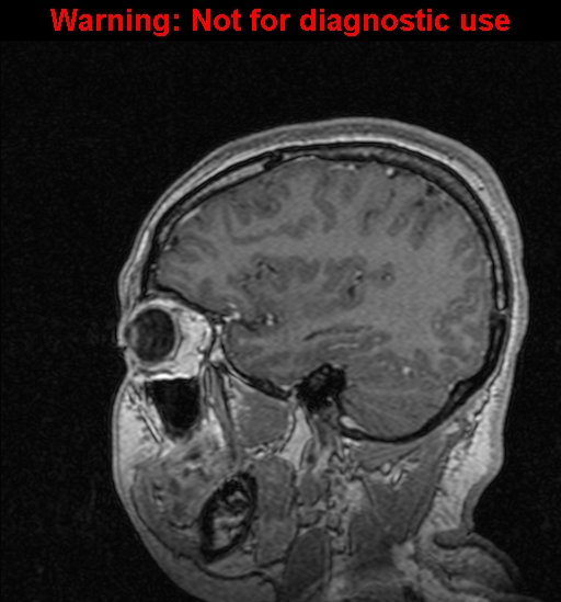 Cerebral venous thrombosis (Radiopaedia 37224-39208 Sagittal T1 C+ 42).jpg