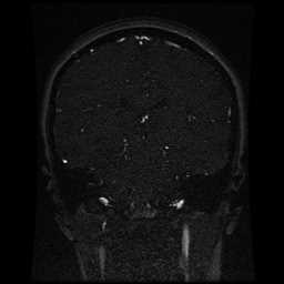 Cerebral venous thrombosis - ulcerative colitis (Radiopaedia 66049-75219 Coronal MRV 51).jpg