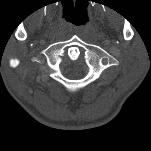 Cervical Pott disease (Radiopaedia 20374-20286 Axial bone window 22).jpg