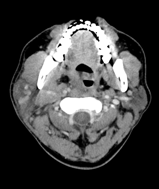 Cervical abscess (Radiopaedia 43725-47184 A 19).png