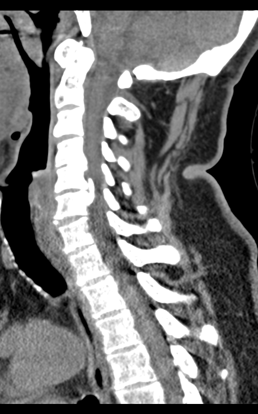 Cervical canal stenosis due to ossification of the posterior longitudinal ligament (Radiopaedia 47260-51823 D 38).png