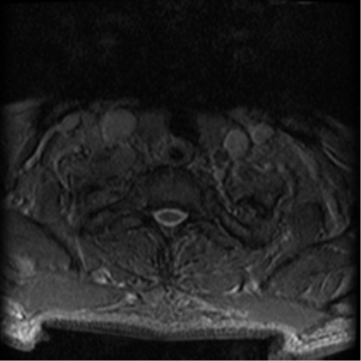 Cervical canal stenosis with cord compression (Radiopaedia 34114-35374 Axial Gradient Echo 8).png