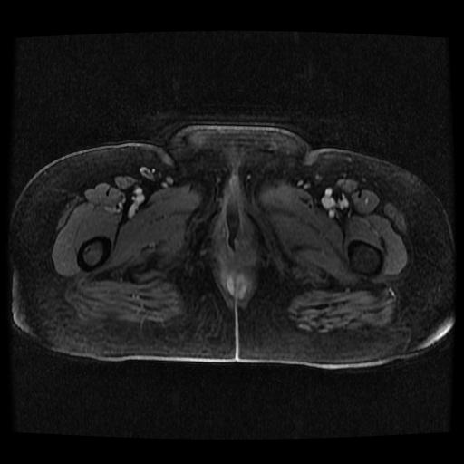 Cervical carcinoma (Radiopaedia 70924-81132 Axial T1 C+ fat sat 193).jpg