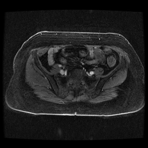Cervical carcinoma (Radiopaedia 70924-81132 Axial T1 C+ fat sat 248).jpg