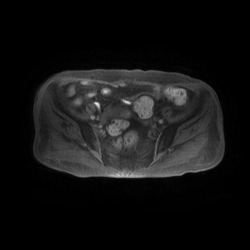 File:Cervical carcinoma (Radiopaedia 78847-91705 Axial T1 fat sat 5).jpg