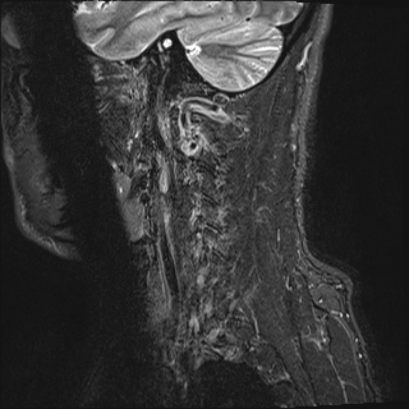File:Cervical disc extrusion (Radiopaedia 53950-60077 Sagittal STIR 2).jpg