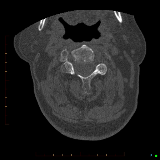Cervical spine fracture - ankylosing spondylitis (Radiopaedia 76835-88706 Axial bone window 69).jpg