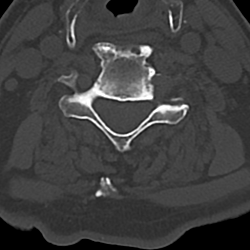 File:Cervical spine fracture - chalk stick (Radiopaedia 39116-41323 Axial bone window 54).png