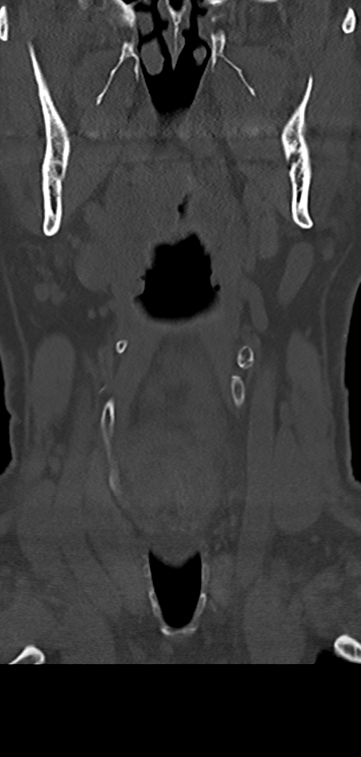 Cervical spine fracture - chalk stick (Radiopaedia 39116-41323 Coronal bone window 8).png