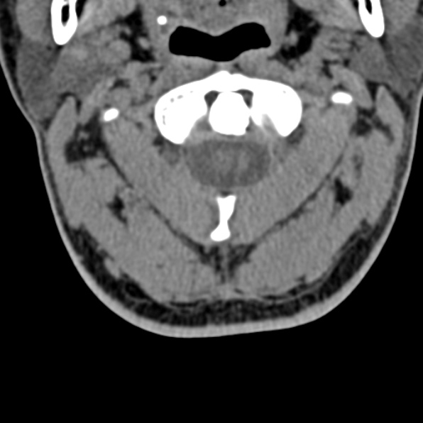 File:Cervical spondylodiscitis (Radiopaedia 28057-29489 Axial non-contrast 21).jpg