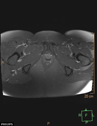 File:Cesarian scar endometriosis (Radiopaedia 68495-78066 Axial T1 C+ fat sat 25).jpg