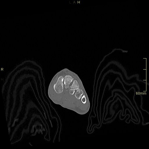 Chaput tubercle fracture (Radiopaedia 80319-93956 Coronal non-contrast 12).jpg