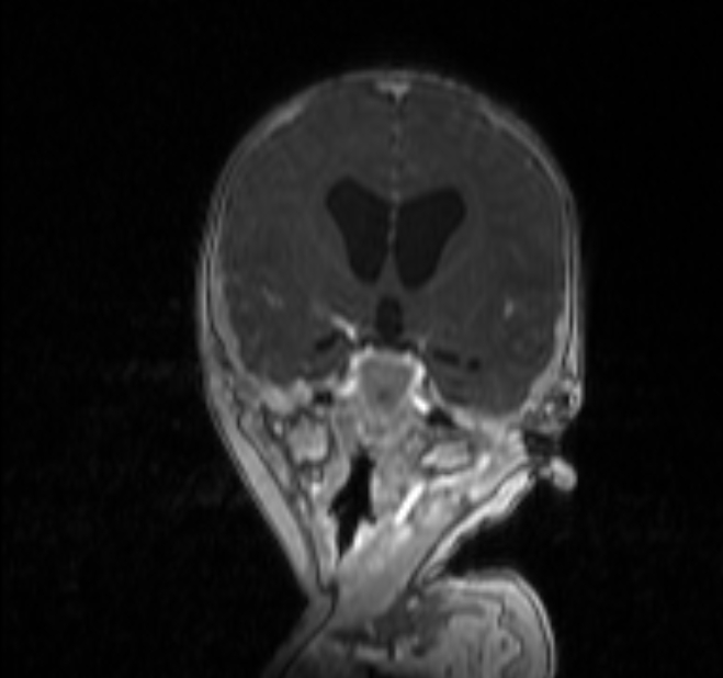 Chiari III malformation with occipital encephalocele (Radiopaedia 79446-92559 Coronal T1 C+ mpr 11).jpg