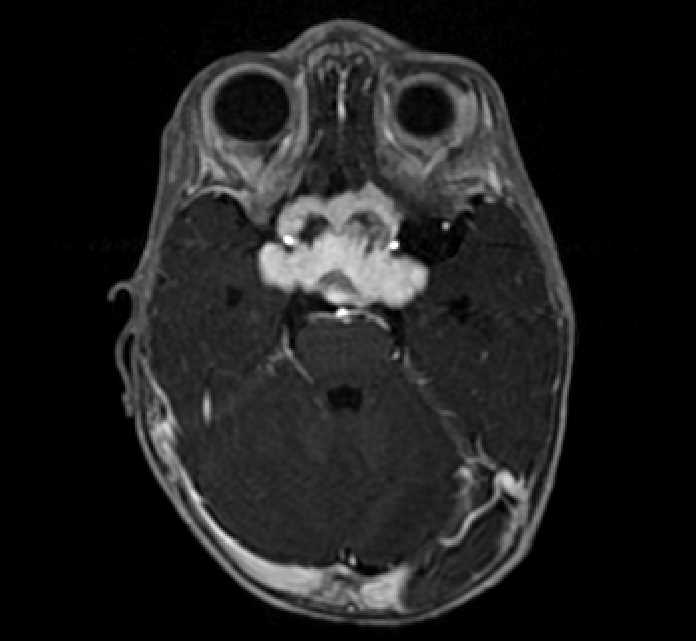 Chiasmatic-hypothalamic glioma (Radiopaedia 90079-107252 Axial T1 C+ 26).jpg