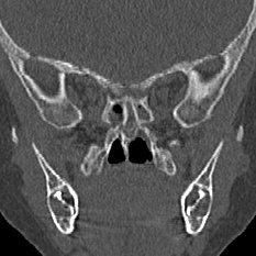 Choanal atresia (Radiopaedia 88525-105975 Coronal bone window 71).jpg