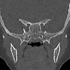 Choanal atresia (Radiopaedia 88525-105975 Coronal bone window 88).jpg