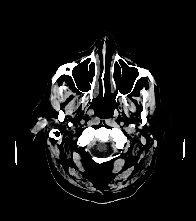 Cholangiocarcinoma with cerebral metastases (Radiopaedia 83519-98628 Axial non-contrast 9).jpg