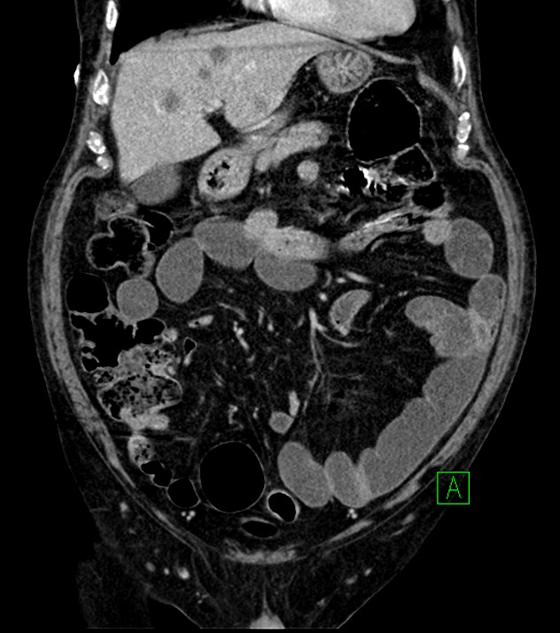 Cholangiocarcinoma with cerebral metastases (Radiopaedia 83519-98629 G 26).jpg