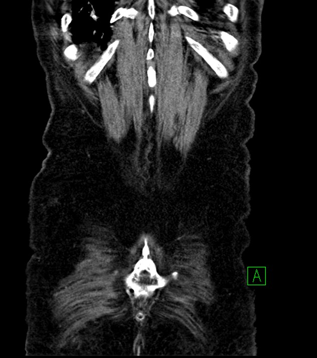 Cholangiocarcinoma with cerebral metastases (Radiopaedia 83519-98629 G 76).jpg