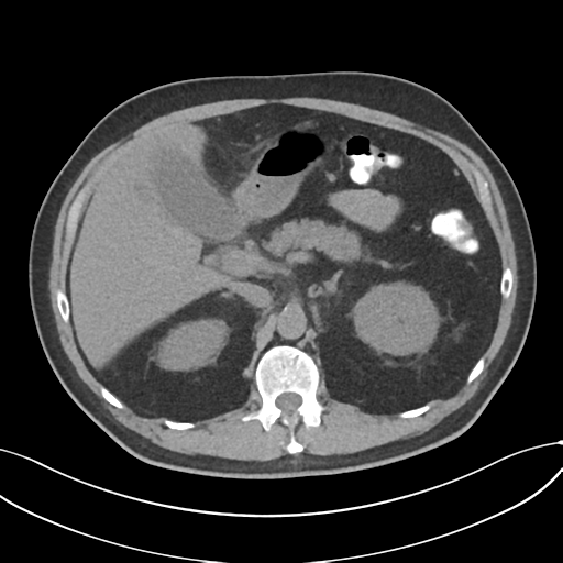 File:Cholecystitis with focal perforation and hepatic abscess (Radiopaedia 37189-38945 Axial non-contrast 27).png