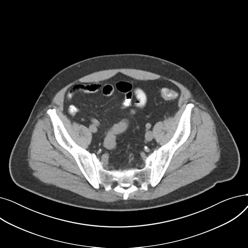 Cholecystitis with focal perforation and hepatic abscess (Radiopaedia 37189-38945 Axial non-contrast 69).png