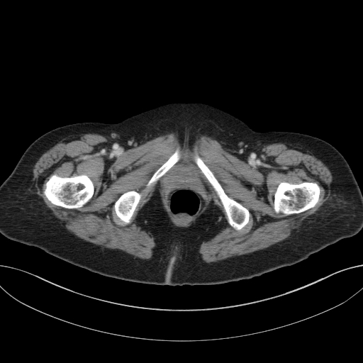 Cholecystoduodenal fistula due to calculous cholecystitis with gallstone migration (Radiopaedia 86875-103077 D 84).jpg