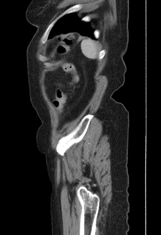 Cholecystoduodenal fistula due to calculous cholecystitis with gallstone migration (Radiopaedia 86875-103077 F 4).jpg