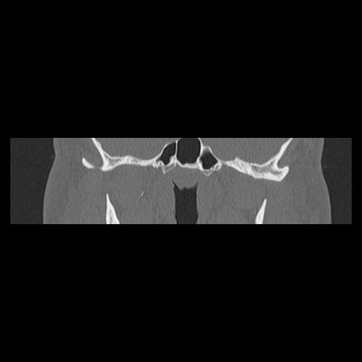 Cholesteatoma (Radiopaedia 84946-100455 Coronal bone window 75).jpg