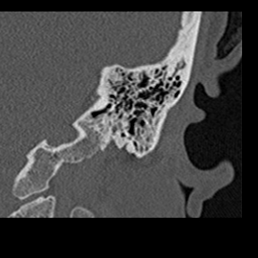 File:Cholesteatoma of the external ear (Radiopaedia 16540-16225 Coronal bone window 22).jpg