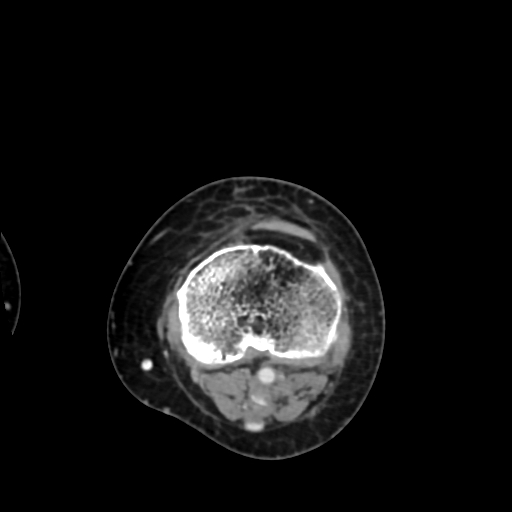 Chondrosarcoma - femur (Radiopaedia 64187-72954 Axial with contrast 63).jpg
