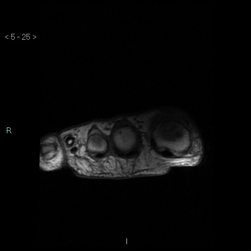 File:Chondrosarcoma - phalanx (Radiopaedia 69047-78813 Axial T1 25).jpg